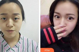 蕪湖一秒醫(yī)療美容醫(yī)院王惠梅整形價格表附雙眼皮案例展示
