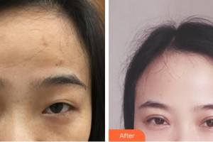 蕪湖一秒醫(yī)療美容醫(yī)院邢程整形價格表附眼部綜合案例展示