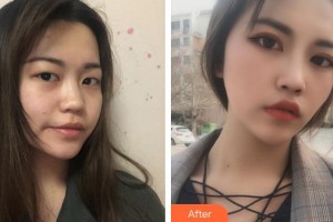 蕪湖一秒醫(yī)療美容醫(yī)院樸成浩整形價格表附眼部綜合案例展示