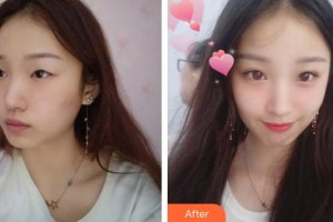 蕪湖一秒醫(yī)療美容醫(yī)院劉明明整形價格表附眼部綜合案例展示