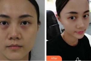 蕪湖眼科醫(yī)院（弋江區(qū)醫(yī)院）周麗整形價格表附雙眼皮案例展示