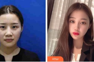 蕪湖眼科醫(yī)院（弋江區(qū)醫(yī)院）李燕整形價格表附雙眼皮案例展示