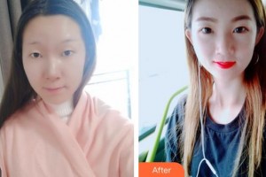 蕪湖眼科醫(yī)院（弋江區(qū)醫(yī)院）韓林峰整形價格表附切開雙眼皮案例展示