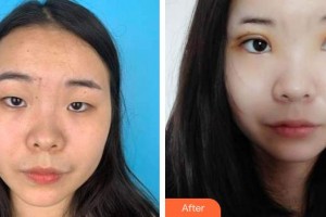 蕪湖眼科醫(yī)院（弋江區(qū)醫(yī)院）王繼兵整形價格表附外切祛眼袋案例展示