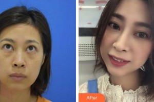 蕪湖眼科醫(yī)院（弋江區(qū)醫(yī)院）盛永紅整形價格表附激光去眼袋案例展示