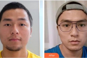 蕪湖眼科醫(yī)院（弋江區(qū)醫(yī)院）史椰欖整形價格表附切開雙眼皮案例展示