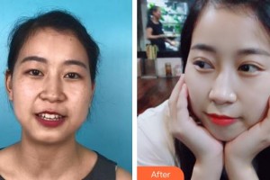 蕪湖眼科醫(yī)院（弋江區(qū)醫(yī)院）晉毓信整形價格表附雙眼皮案例展示