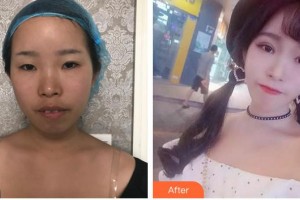 蕪湖眼科醫(yī)院（弋江區(qū)醫(yī)院）高際平整形價格表附切開雙眼皮案例展示