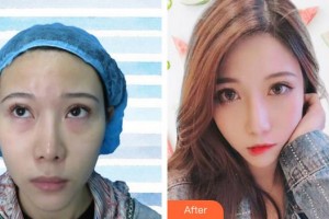 蕪湖眼科醫(yī)院（弋江區(qū)醫(yī)院）張雷整形價格表附內(nèi)切祛眼袋案例展示