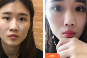 蕪湖眼科醫(yī)院（弋江區(qū)醫(yī)院）王國平整形價格表附切開雙眼皮案例展示