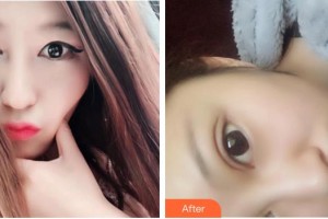 蕪湖眼科醫(yī)院（弋江區(qū)醫(yī)院）孫功勛整形價格表附雙眼皮案例展示