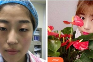 蕪湖眼科醫(yī)院（弋江區(qū)醫(yī)院）周仕福整形價格表附雙眼皮案例展示