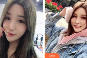 蕪湖愛爾眼科醫(yī)院王飛整形價格表附眼部修復(fù)案例展示