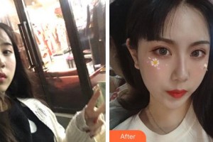 蕪湖眼科醫(yī)院（弋江區(qū)醫(yī)院）李惠整形價格表附雙眼皮案例展示