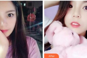 蕪湖市口腔醫(yī)院金紅軍整形價格表附牙齒隱形矯正案例展示