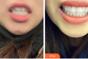 蕪湖市口腔醫(yī)院張彪整形價格表附隱形托槽矯正案例展示