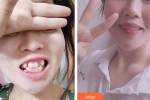 蕪湖來(lái)友口腔門(mén)診部張來(lái)友整形價(jià)格表附金屬托槽矯正案例展示