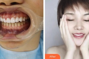 蕪湖市口腔醫(yī)院朱羅莎整形價(jià)格表附美白貼片案例展示