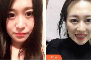 蕪湖新時(shí)代口腔門(mén)診部顧瑩整形價(jià)格表附金屬托槽矯正案例展示