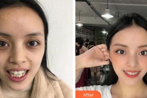 蕪湖來(lái)友口腔門(mén)診部陳天蘊(yùn)整形價(jià)格表附牙齒矯正案例展示