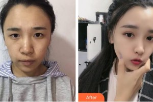 蚌埠國(guó)色整形美容醫(yī)院程新德整形價(jià)格表附眼部綜合案例展示