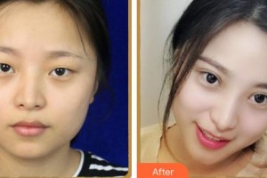 蚌埠國(guó)色整形美容醫(yī)院丁美哲整形價(jià)格表附眼部綜合案例展示