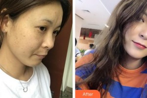 蚌埠華美整形美容門診部王榮堂整形價(jià)格表附激光美膚激光案例展示