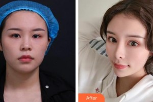 蚌埠市第三人民醫(yī)院燒傷整形科章祥洲整形價(jià)格表附鼻部綜合案例展示