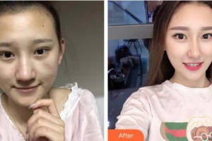 蚌埠華美整形美容門診部袁振奮整形價(jià)格表附微創(chuàng)疤痕修復(fù)案例展示