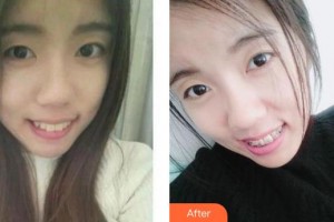 蚌埠韓麗整形美容醫(yī)院盛十中整形價格表附牙齒矯正案例展示