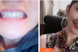 蚌埠韓麗整形美容醫(yī)院王文江整形價格表附牙齒陶瓷矯正案例展示