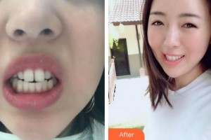 蚌埠韓麗整形美容醫(yī)院張建鋒整形價格表附牙齒矯正案例展示