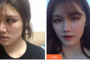 蚌埠韓麗整形美容醫(yī)院洪志堅整形價格表附埋線提升案例展示