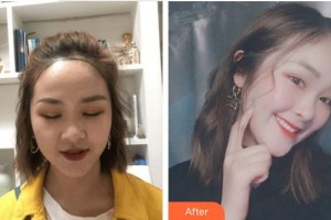 蚌埠韓麗整形美容醫(yī)院柳熙中整形價格表附種植發(fā)際線案例展示