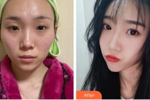 蚌埠韓麗整形美容醫(yī)院李準馥整形價格表附顴骨內(nèi)推案例展示