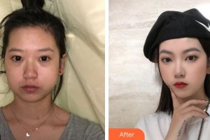 蚌埠韓麗整形美容醫(yī)院金男昊整形價(jià)格表附下頜角整形案例展示