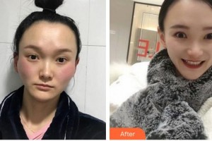 蚌埠靚妹醫(yī)療美容門診部魯立整形價(jià)格表附顴骨顴弓整形術(shù)案例展示