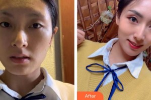 蚌埠時(shí)光鎖美容整形外科診所孟凡照整形價(jià)格表附埋線提升案例展示