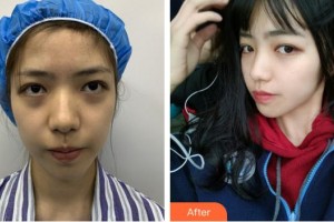 蚌埠立方醫(yī)療美容整形醫(yī)院韓洪方整形價(jià)格表附埋線提升案例展示