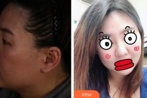 蚌埠華美整形美容門診部劉敏整形價(jià)格表附埋線提升案例展示