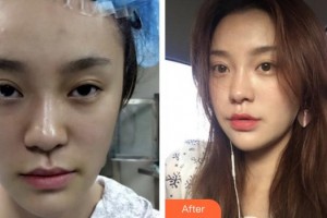 蚌埠韓美美萊醫(yī)療美容門診部張燕整形價(jià)格表附埋線提升案例展示