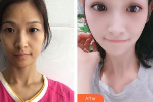 蚌埠市交通醫(yī)院醫(yī)療美容科劉永濤整形價(jià)格表附眼部綜合案例展示