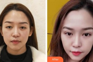 蚌埠康視眼科醫(yī)院甘玲萍整形價格表附眼部整形案例展示