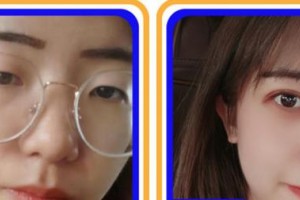 蚌埠愛爾和平眼科醫(yī)院穆勝利整形價格表附眼部綜合案例展示