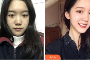 蚌埠康視眼科醫(yī)院李子鵬整形價格表附眼部綜合案例展示