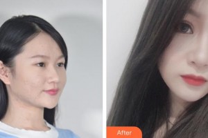 蚌埠懷遠民康醫(yī)院方紅民整形價格表附眼部綜合案例展示