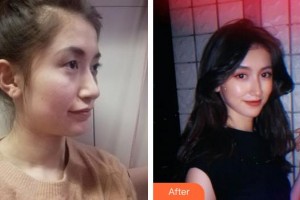 蚌埠愛爾和平眼科醫(yī)院靳懷運整形價格表附眼部綜合案例展示