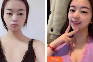 淮南凱婷美琪醫(yī)療美容醫(yī)院曹士華整形價(jià)格表附自體脂肪隆胸案例展示