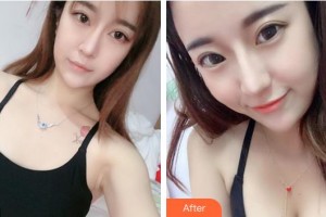 淮南瑞麗醫(yī)療美容門(mén)診部樸鐘洙整形價(jià)格表附自體脂肪隆胸案例展示