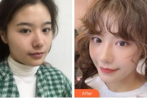 淮南麗人醫(yī)院整形美容科熊秋萍整形價(jià)格表附熱瑪吉案例展示